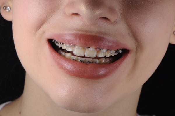 Когда показана установка брекетов